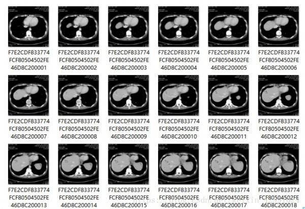 MicroDicom viewer(Dicom��ʽ��ͼ����)